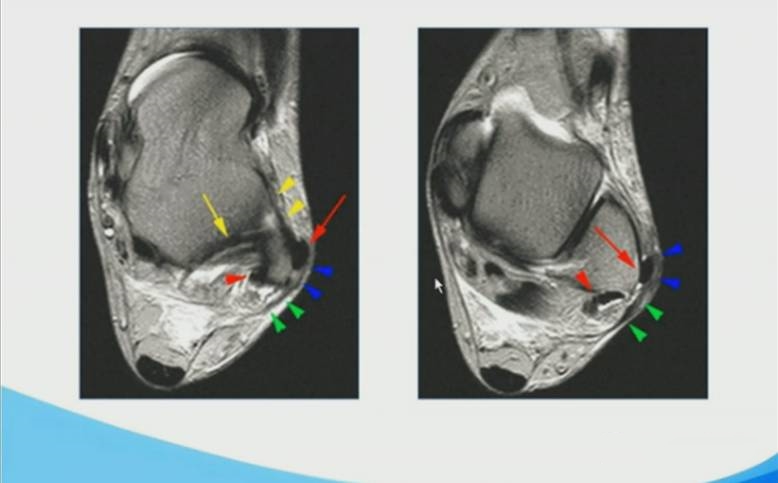 足踝部mri的解剖及诊断要点 好医术早读文章 好医术 赋能医生守护生命