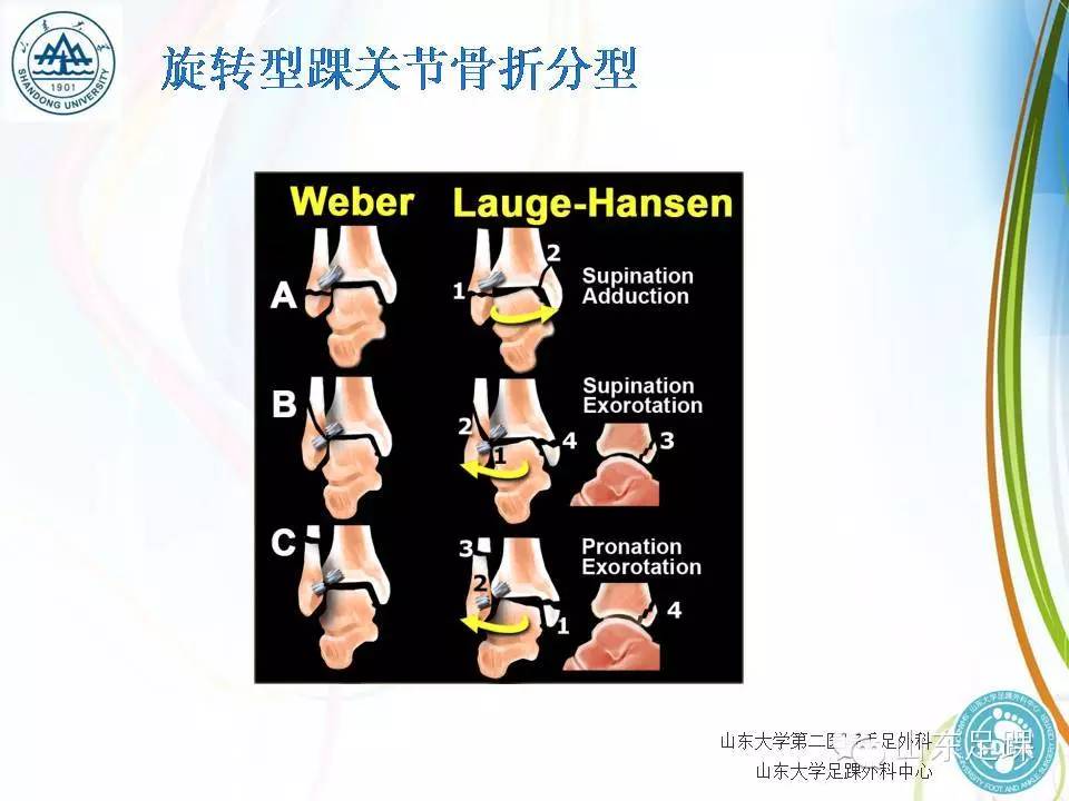 pilon骨折的分型及治疗要点