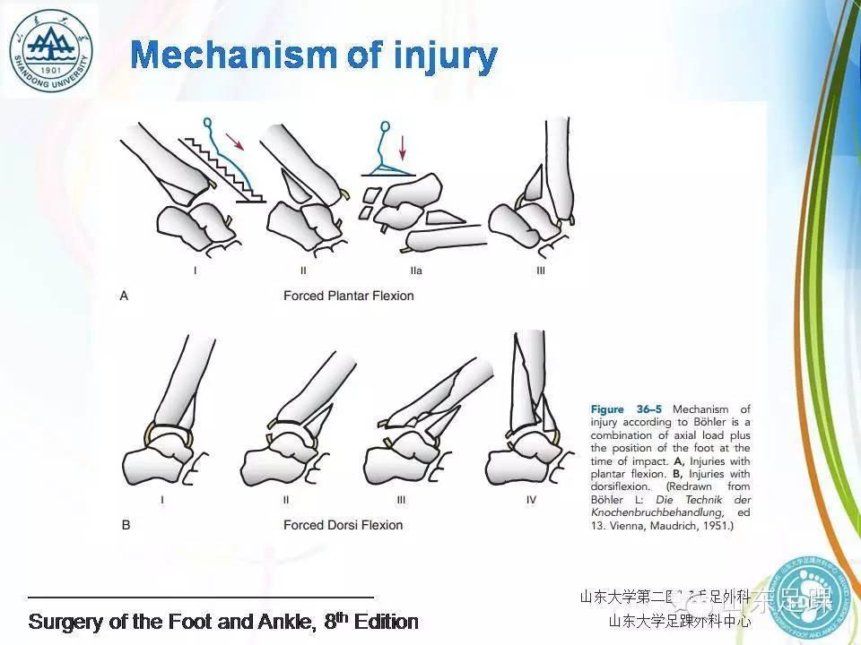 pilon骨折的分型及治疗要点
