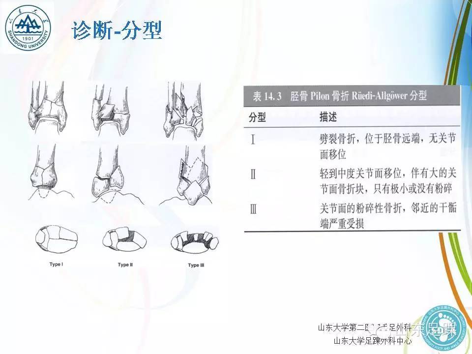 pilon骨折的分型及治疗要点
