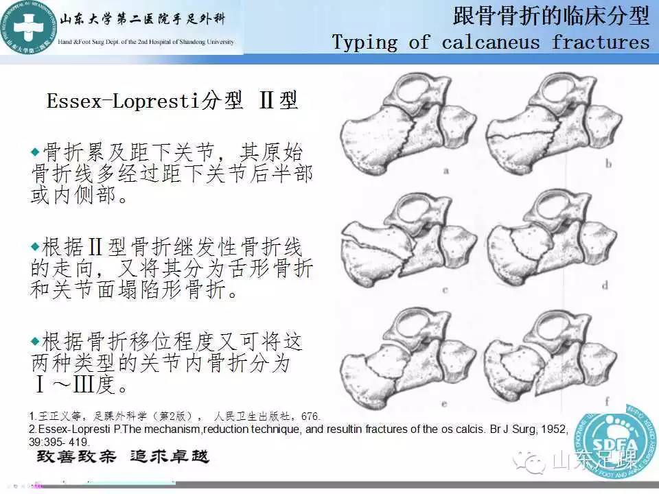 基础 | 详解跟骨骨折的分型 - 好医术早读文章 - 好医术-赋能医生守护生命