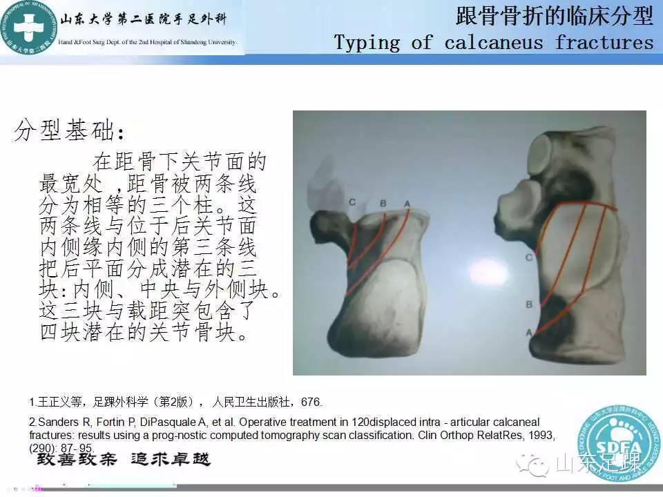 基础 | 详解跟骨骨折的分型 - 好医术早读文章 - 好医术-赋能医生守护生命