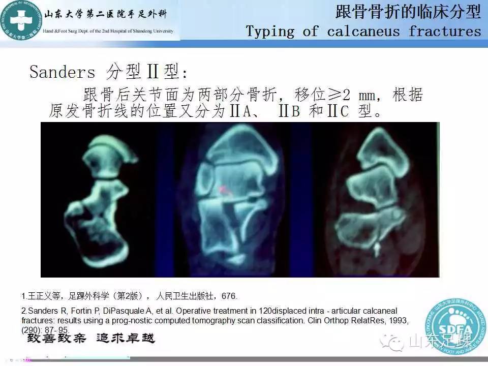 基础 | 详解跟骨骨折的分型 - 好医术早读文章 - 好医术-赋能医生守护生命