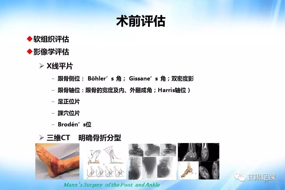 经跗骨窦切口治疗跟骨骨折的新术式
