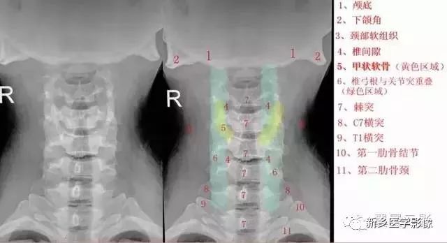 推荐 最详细的颈椎x线解剖 好医术早读文章 好医术 赋能医生守护生命