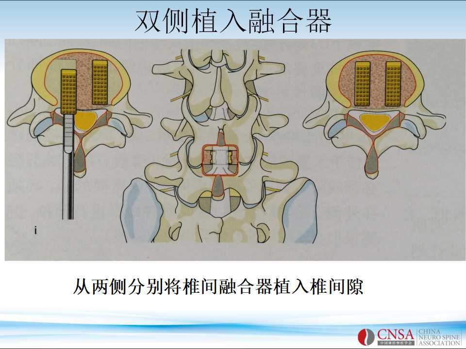 脊柱融合术的方法及技巧