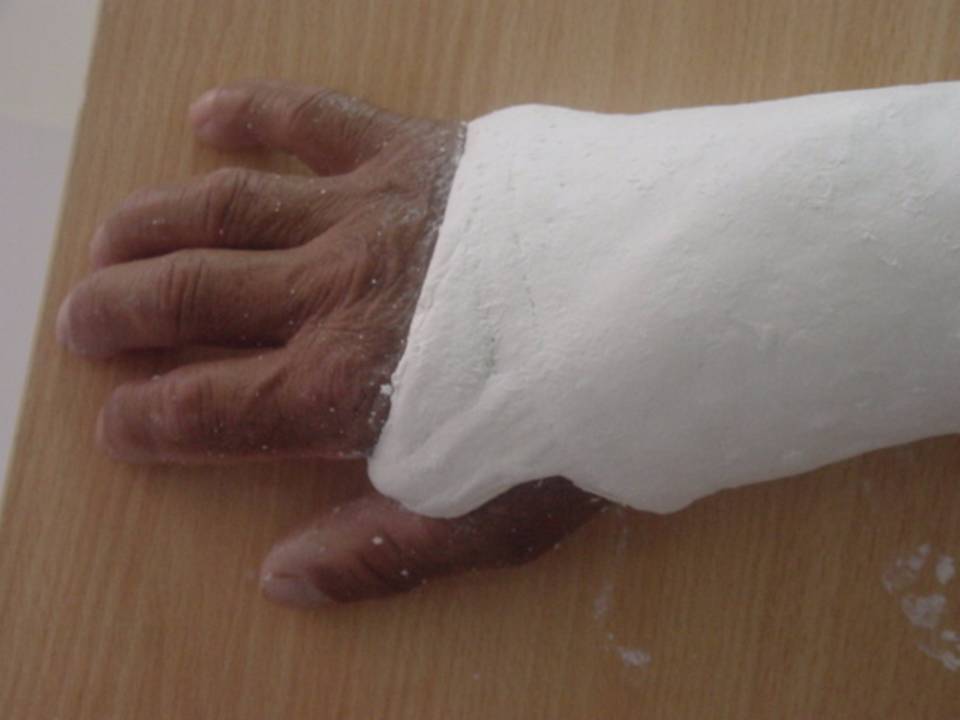 推荐 四肢骨折后石膏外固定详解 好医术早读文章 好医术 赋能医生守护生命