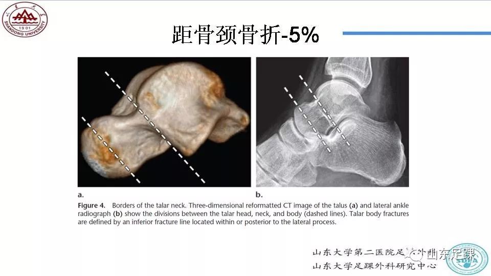 距骨骨折概述 好医术早读文章 好医术 赋能医生守护生命 