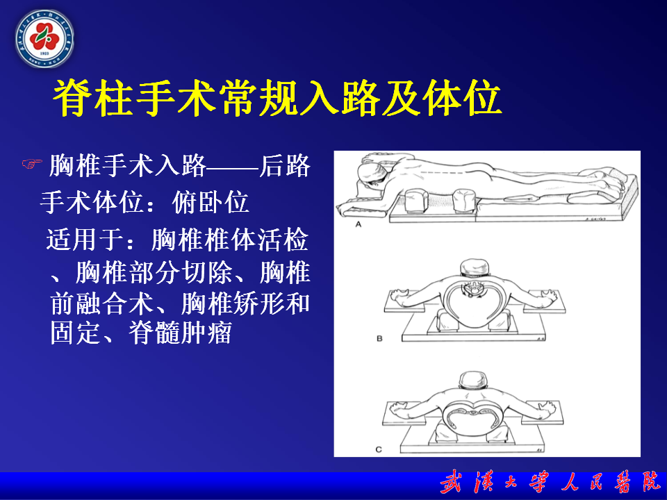 脊柱手术体位及配合要点 - 好医术早读文章 - 好医术-赋能医生守护生命