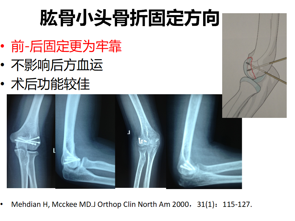 肱骨小頭骨折臨床治療與手術技巧