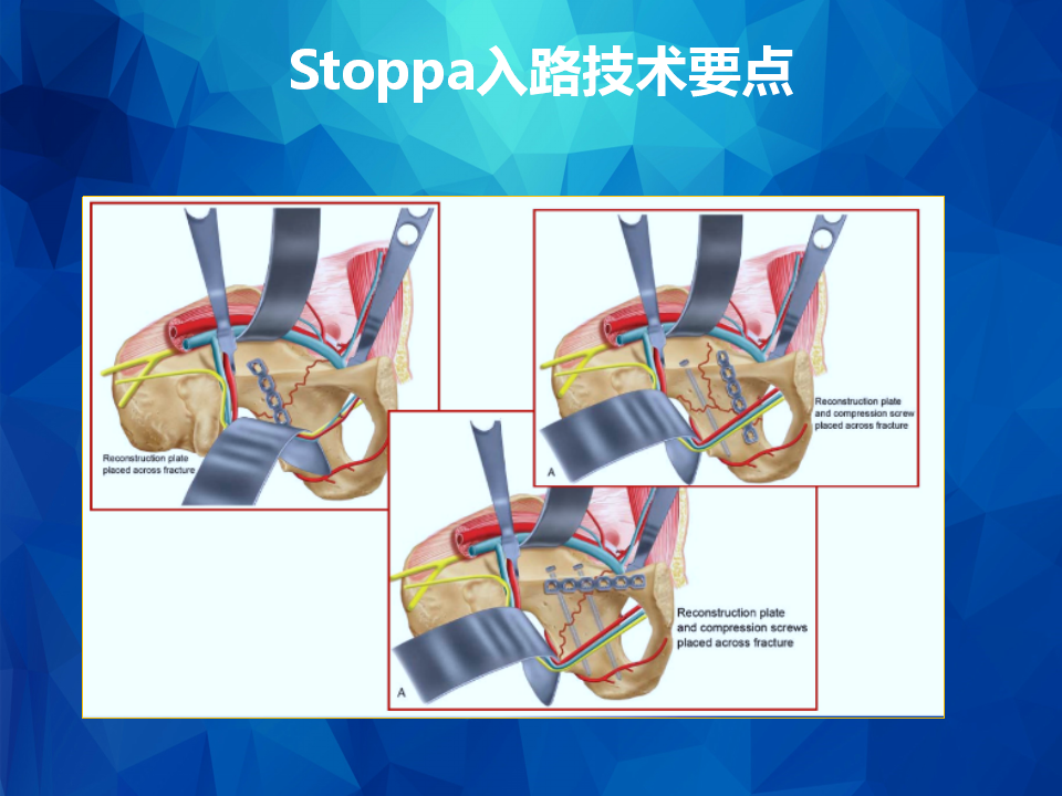 stoppa及其改良入路治疗骨盆髋臼骨折
