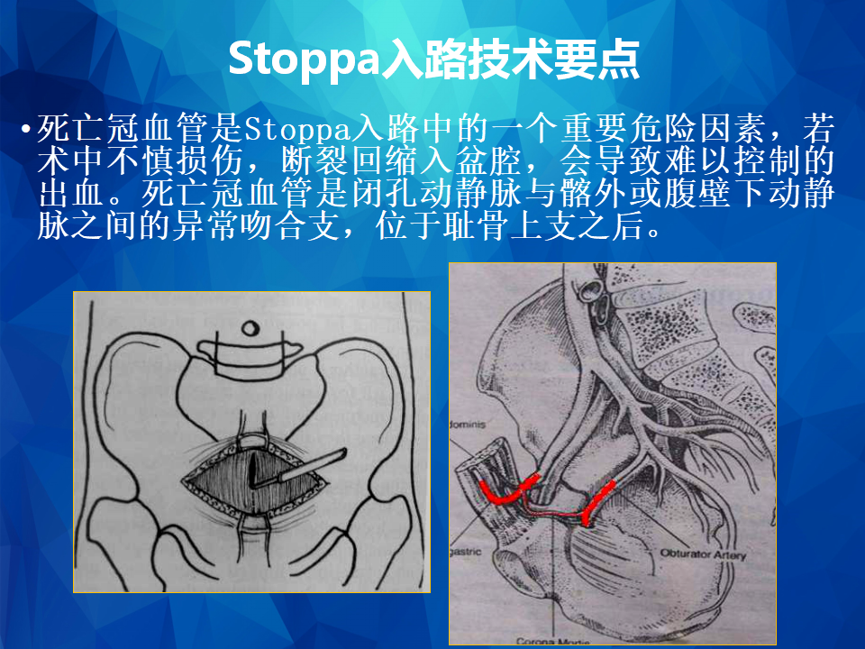 stoppa及其改良入路治疗骨盆髋臼骨折