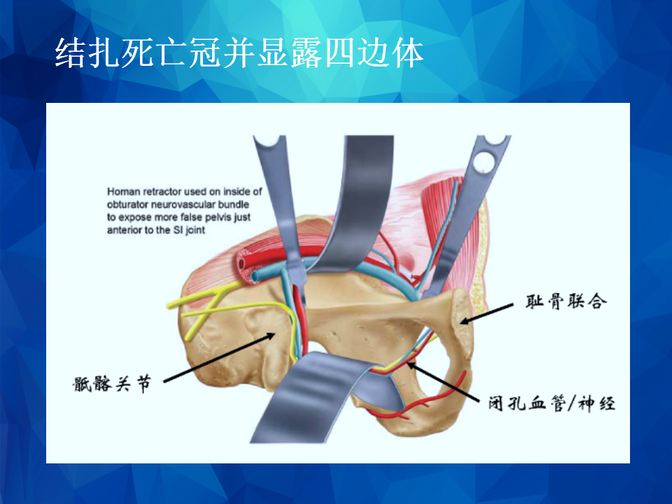 stoppa及其改良入路治疗骨盆髋臼骨折
