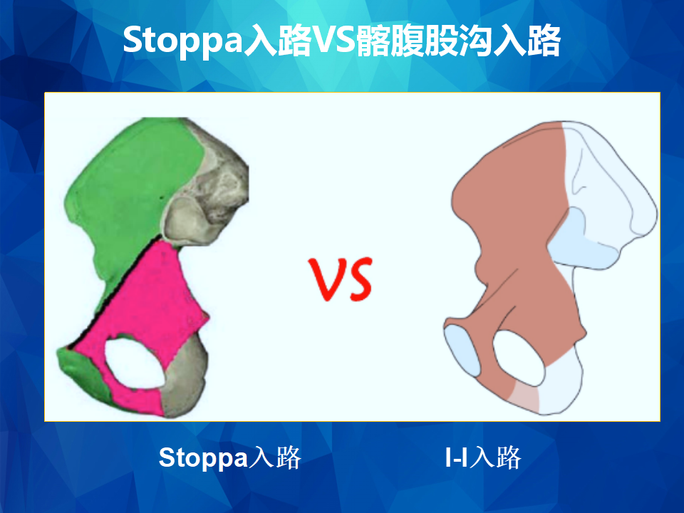 stoppa及其改良入路治疗骨盆髋臼骨折