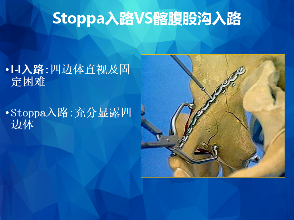 stoppa及其改良入路治疗骨盆髋臼骨折