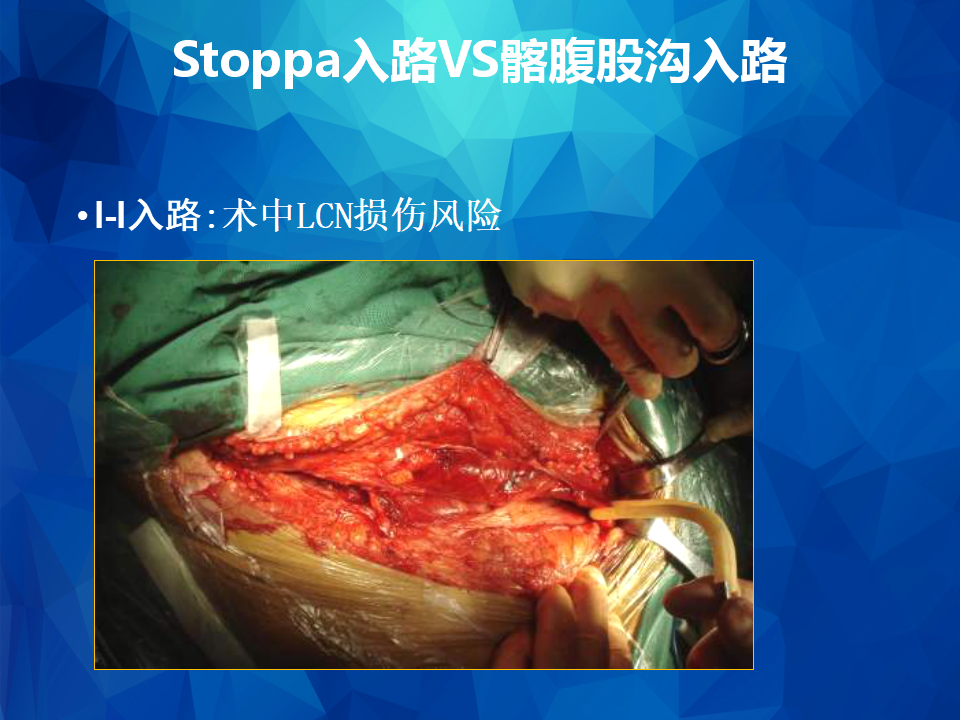 stoppa及其改良入路治疗骨盆髋臼骨折