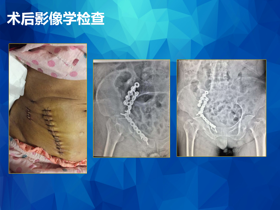 stoppa及其改良入路治疗骨盆髋臼骨折