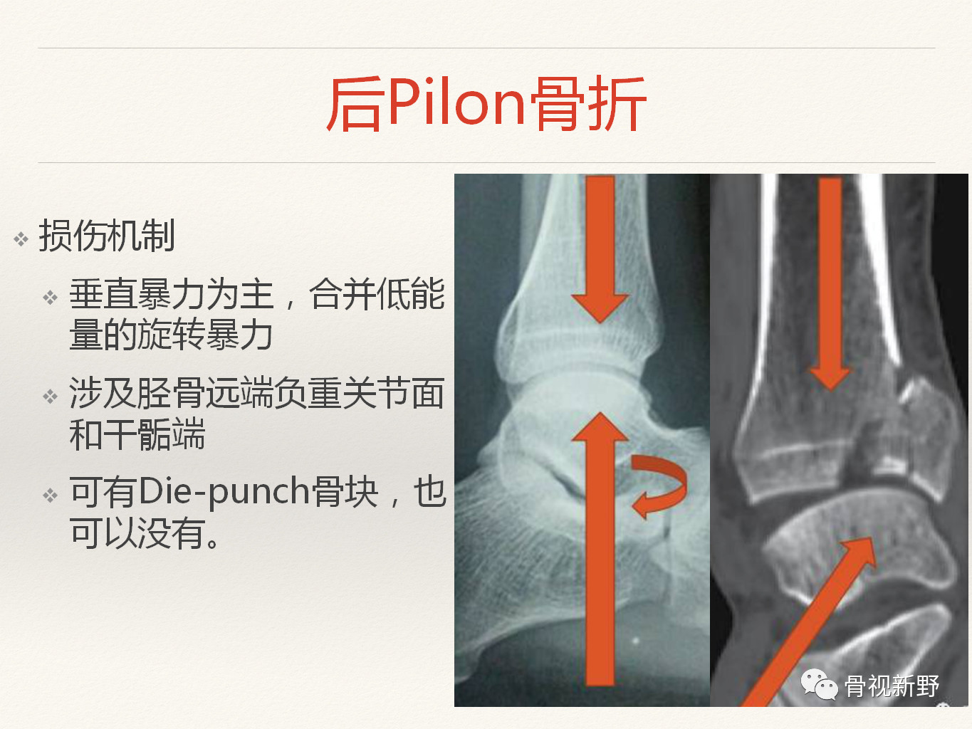 手术技巧 经踝管入路治疗后pilon骨折 好医术早读文章 好医术 帮助医生高效提升医术