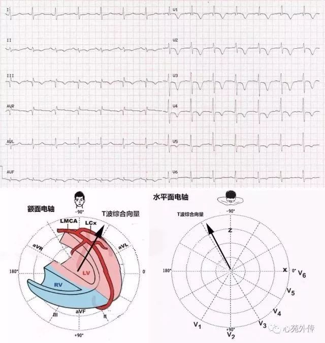 一招搞定全導聯t波倒置