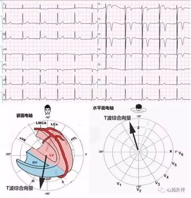 一招搞定全導聯t波倒置