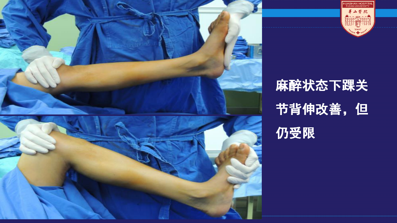 马蹄足手术步骤详细解析,太实用了!