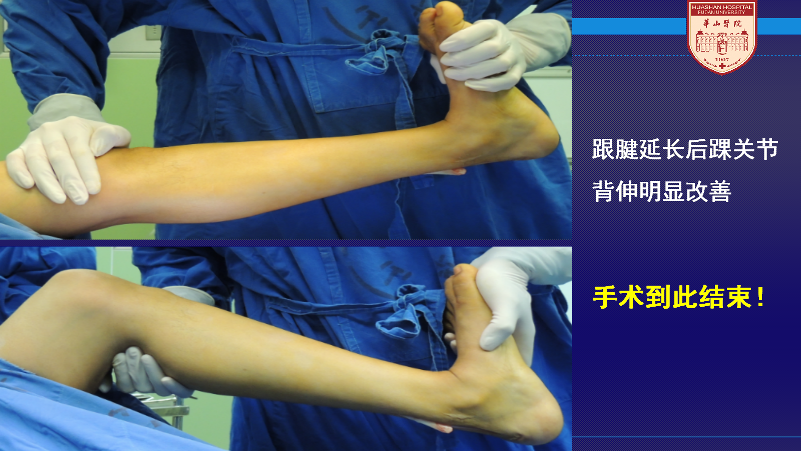 马蹄足手术步骤详细解析,太实用了!