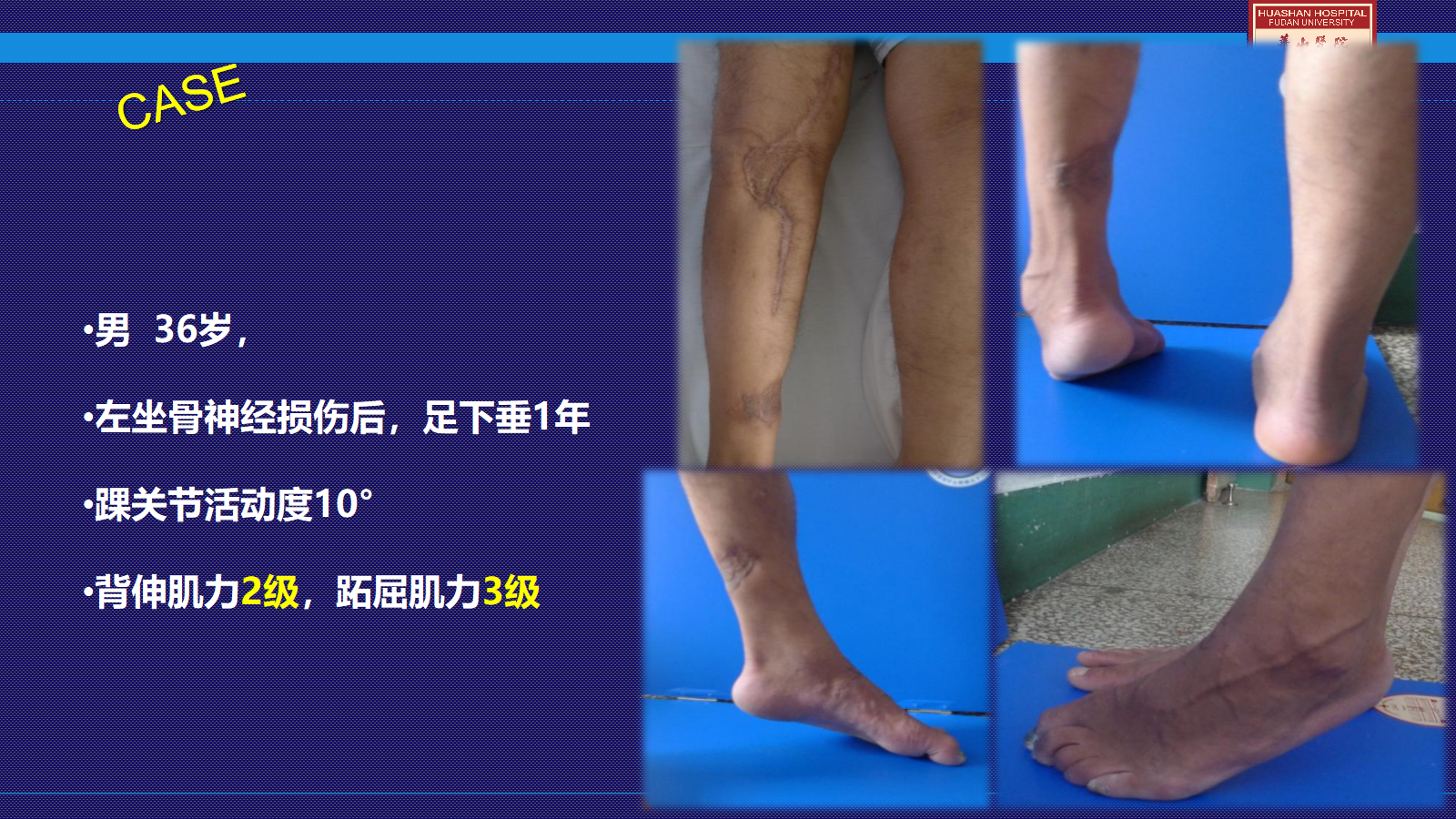 马蹄足手术步骤详细解析,太实用了!