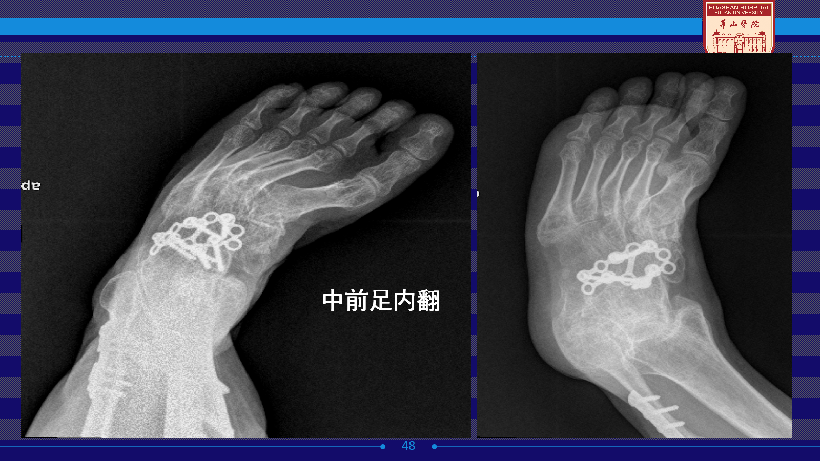 马蹄足手术步骤详细解析,太实用了!