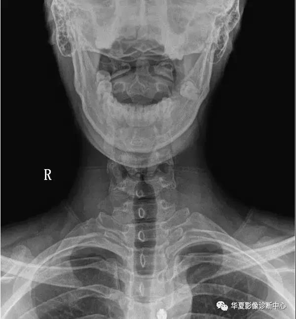 第七颈椎横突有无过长,有无颈肋 钩椎关节及椎间隙有无增宽和狭窄