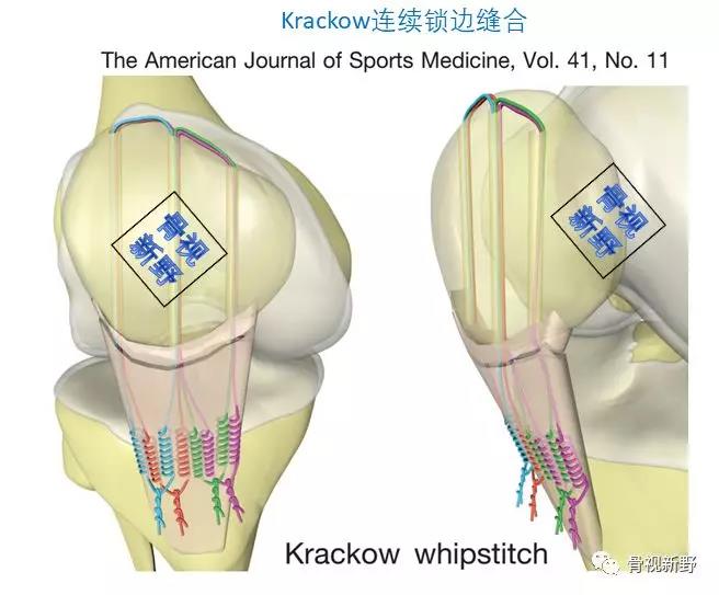 髌韧带撕脱的krackow及其改良缝合方法