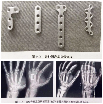 掌指骨骨折的固定方式选择 基础必备 好医术早读文章 好医术 赋能医生守护生命