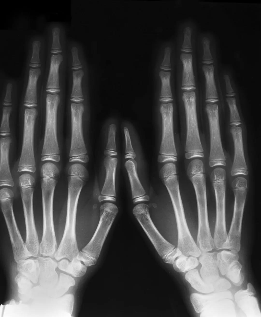 Marfan Syndrome Hand Test