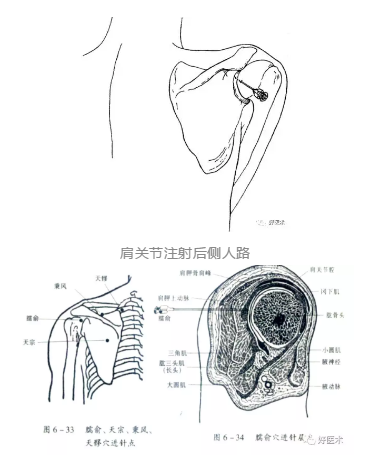 常用关节腔穿刺方法技巧大全