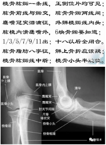 肘关节x线解剖及常见骨折诊断 基础必备 好医术早读文章 好医术 赋能医生守护生命