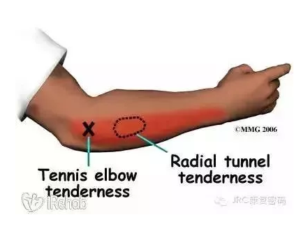 网球肘的诊治策略 值得一看 好医术早读文章 好医术 帮助医生高效提升医术