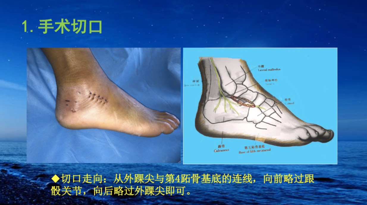 跟骨骨折如何治疗?看完这篇你就会啦