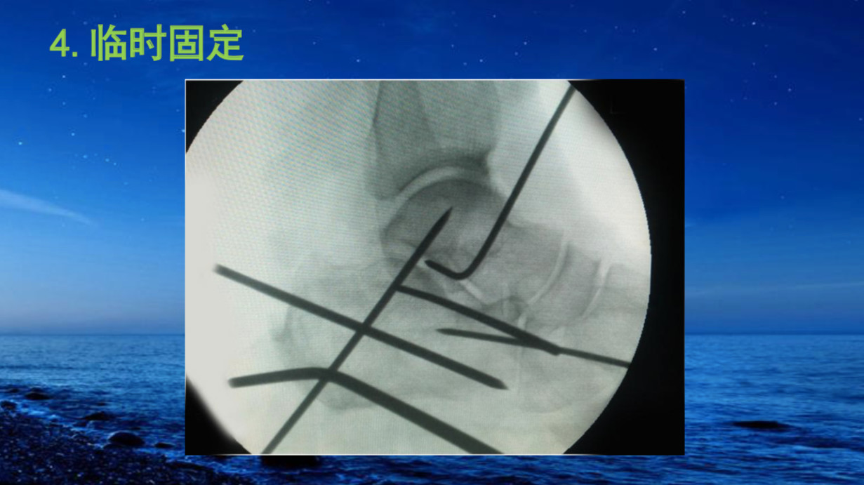 跟骨骨折如何治療?看完這篇你就會啦