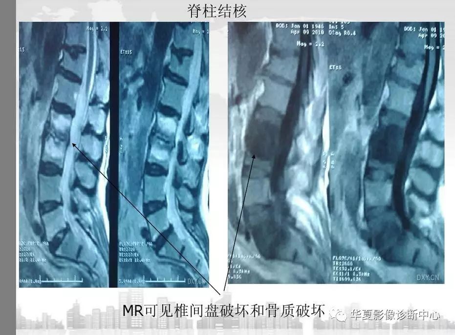 一文详解:椎体终板炎诊断策略