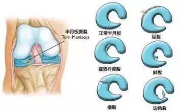 半月板損傷也是常見原因